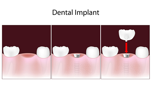 dental implants in Woburn