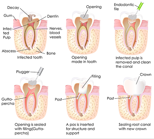 Woburn root canal